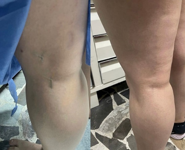 Antes y Después 1