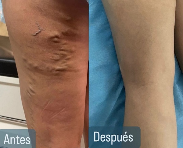 Antes y Después 2