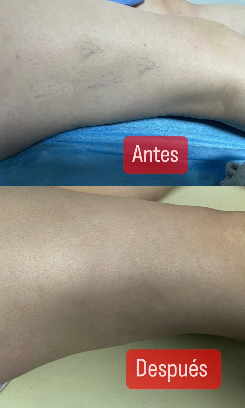 Antes y Después 4
