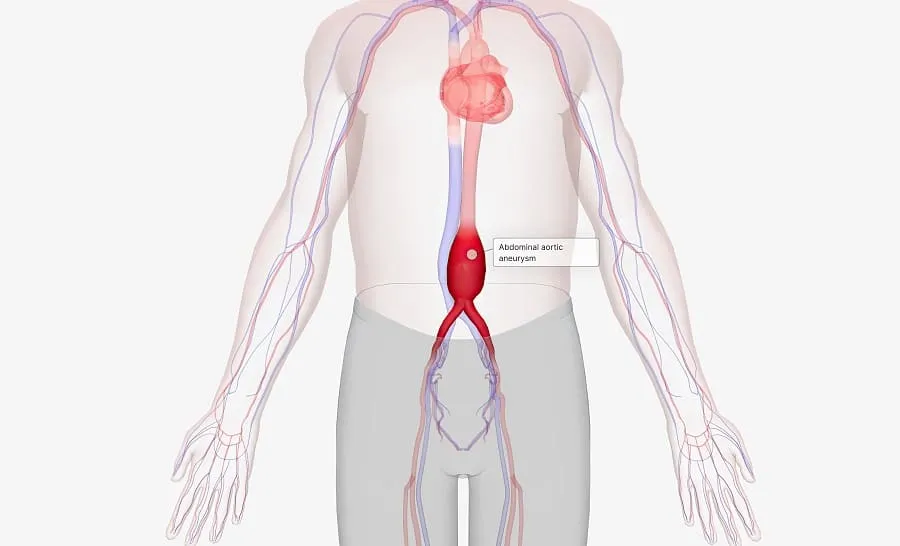 Aneurismas de aorta abdominal y periféricos