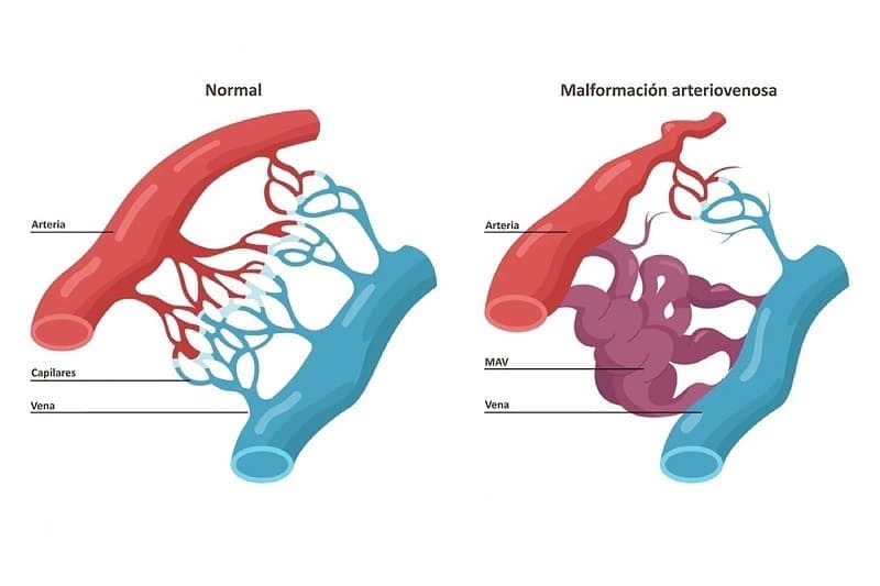 Malformaciones arteriovenosas