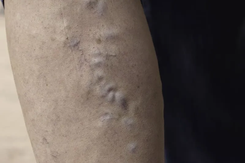 Tromboflebitis superficial