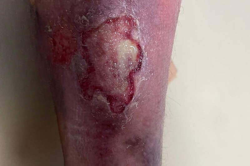 Úlceras Venosas